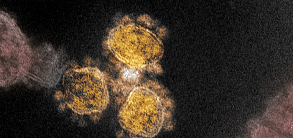 Electron microscope image of the SARS-CoV-2 virus