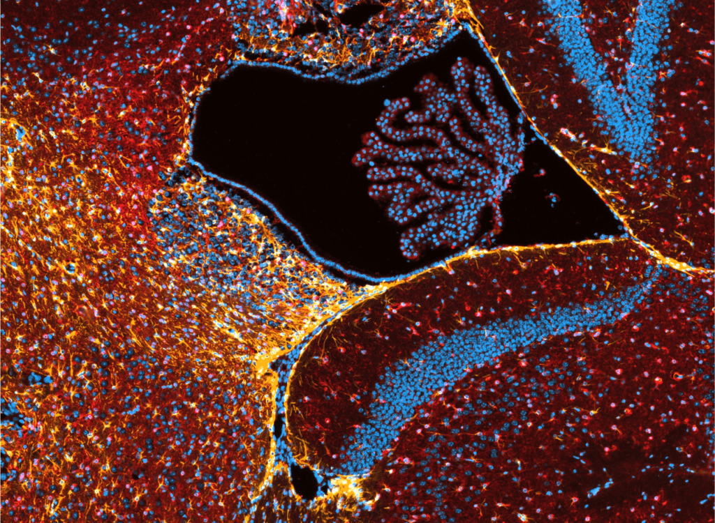 H. Fueling the Fight Glutamine’s Critical Role in Brain Tumor Metabolism (1)