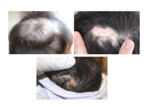 Examples of the scalp scarring that occurs with aplasia cutis.