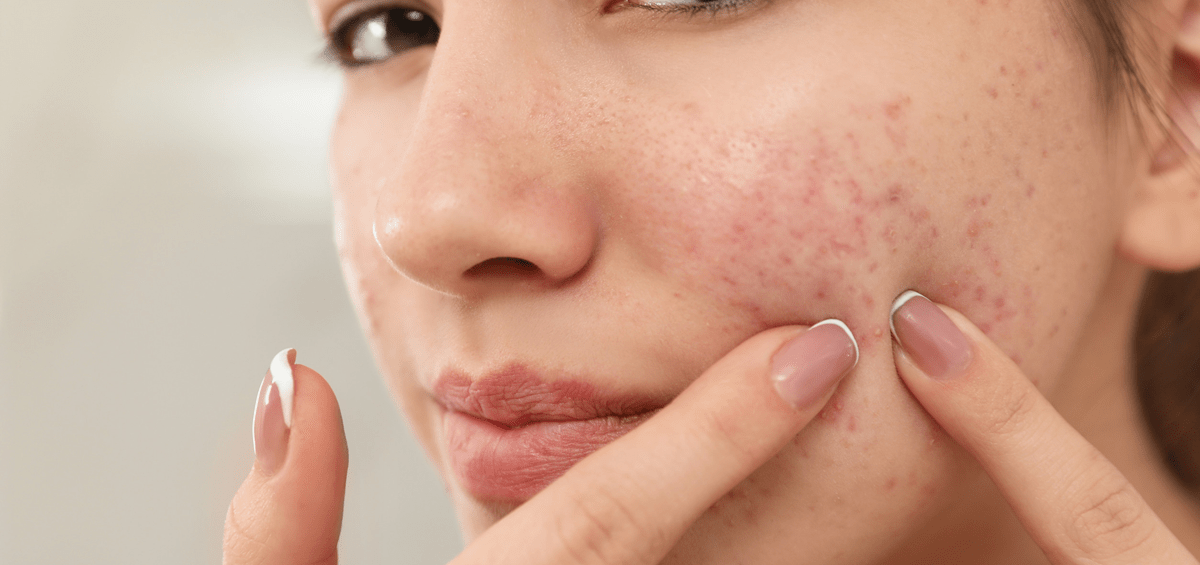 An image of a woman examining blemished skin
